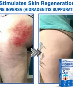 ๐ป๐๐๐บ๐๐๐๐ยฎ 2-in-1 Microneedle & Hydrocolloid Patch