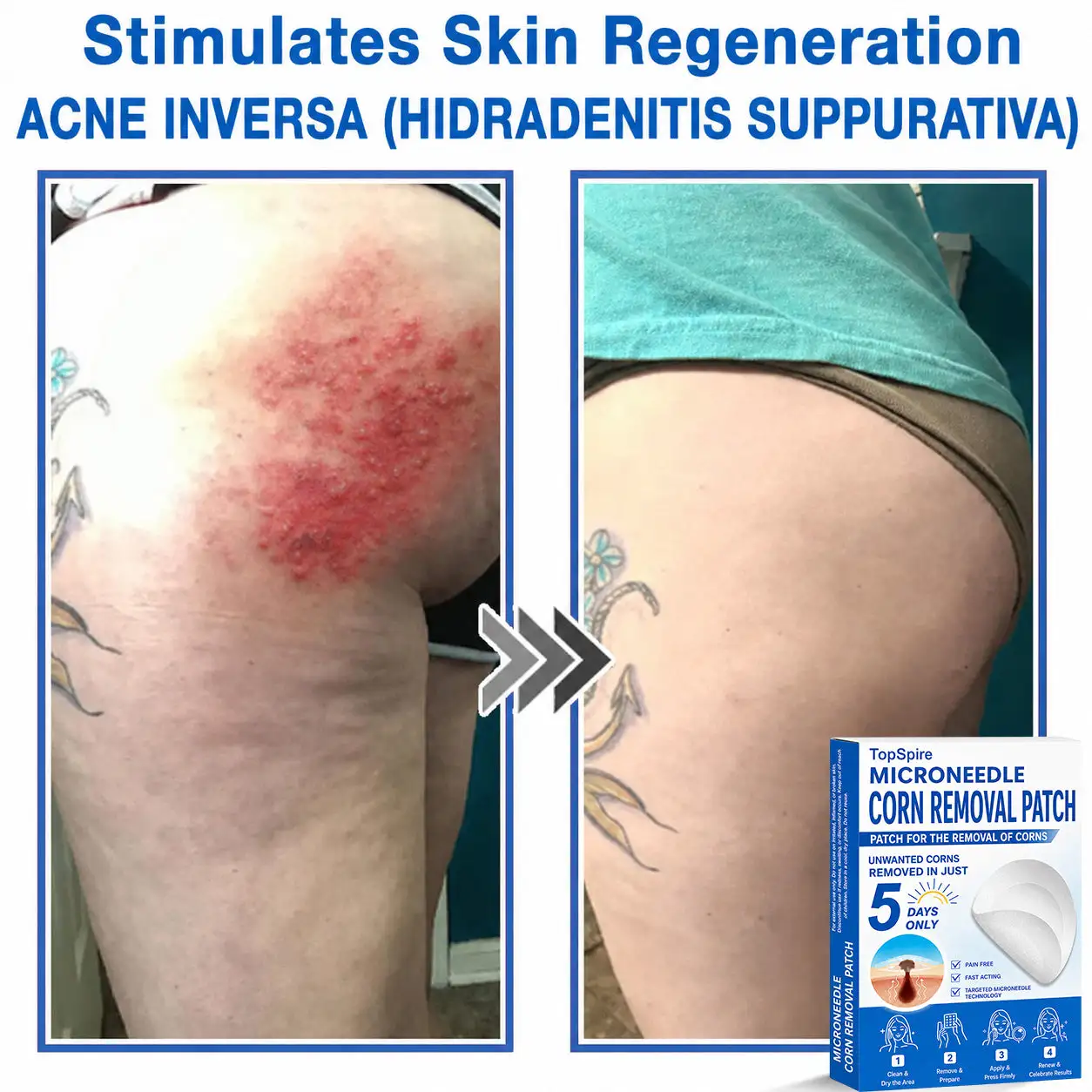 ๐ป๐๐๐บ๐๐๐๐ยฎ 2-in-1 Microneedle & Hydrocolloid Patch