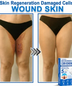๐ป๐๐๐บ๐๐๐๐ยฎ 2-in-1 Microneedle & Hydrocolloid Patch