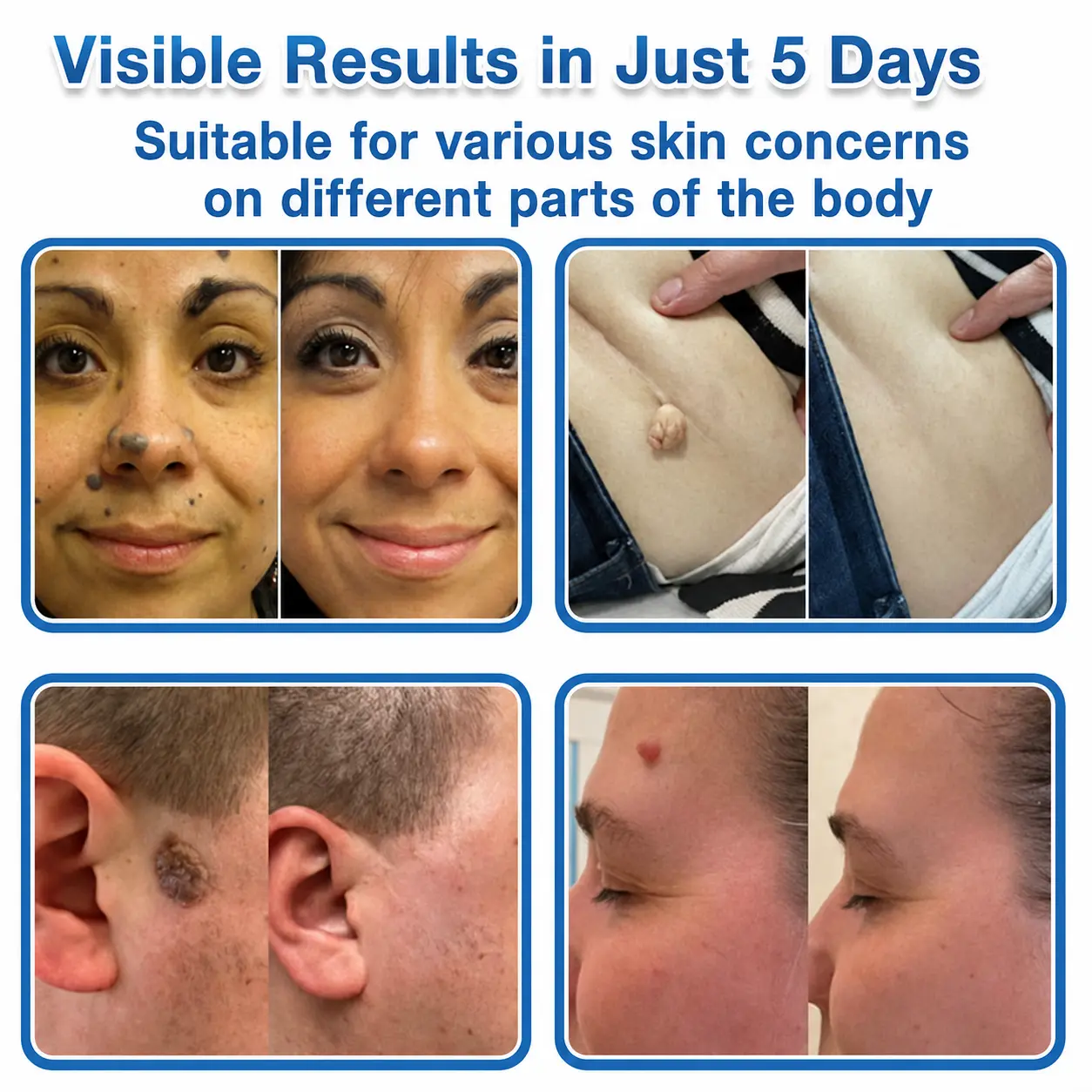 ๐ป๐๐๐บ๐๐๐๐ยฎ 2-in-1 Microneedle & Hydrocolloid Patch