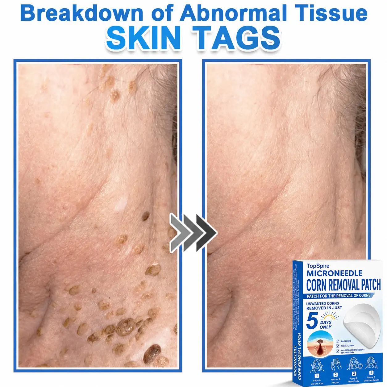 ๐ป๐๐๐บ๐๐๐๐ยฎ 2-in-1 Microneedle & Hydrocolloid Patch
