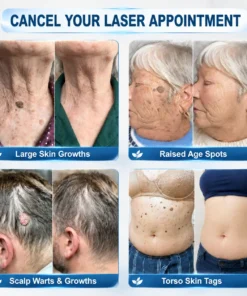 TopSpire® 7-Day 𝗦𝐤𝐢𝐧 𝐓𝐚𝐠 & 𝗪𝐚𝐫𝐭 𝐂𝐚𝐫𝐞 𝐏𝐫𝐞𝐜𝐢𝐬𝐢𝐨𝐧 𝐒𝐰𝐚𝐛𝐬