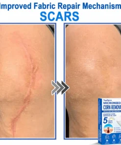 TopSpire® 7-Day Skin Tag & Blemish Remover