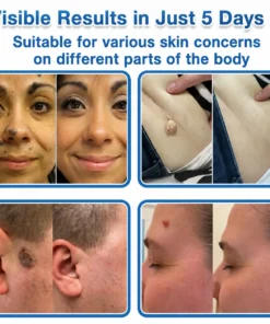 TopSpire® 7-Day Skin Tag & Blemish Remover