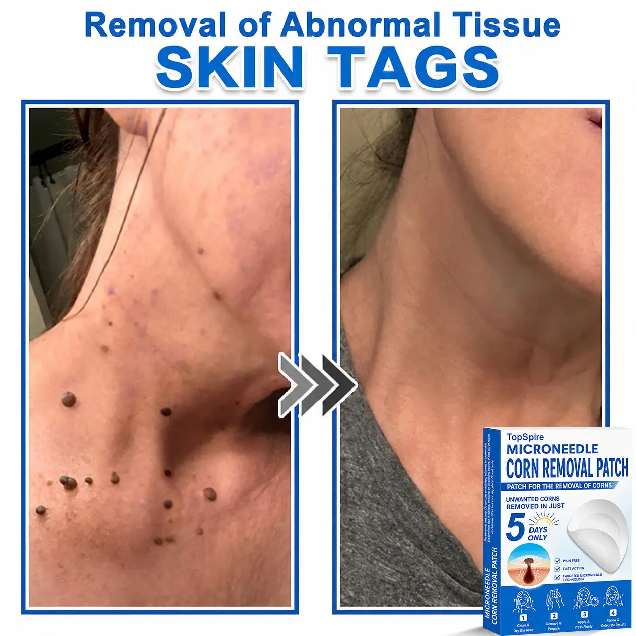 TopSpire® 7-Day Skin Tag & Blemish Remover