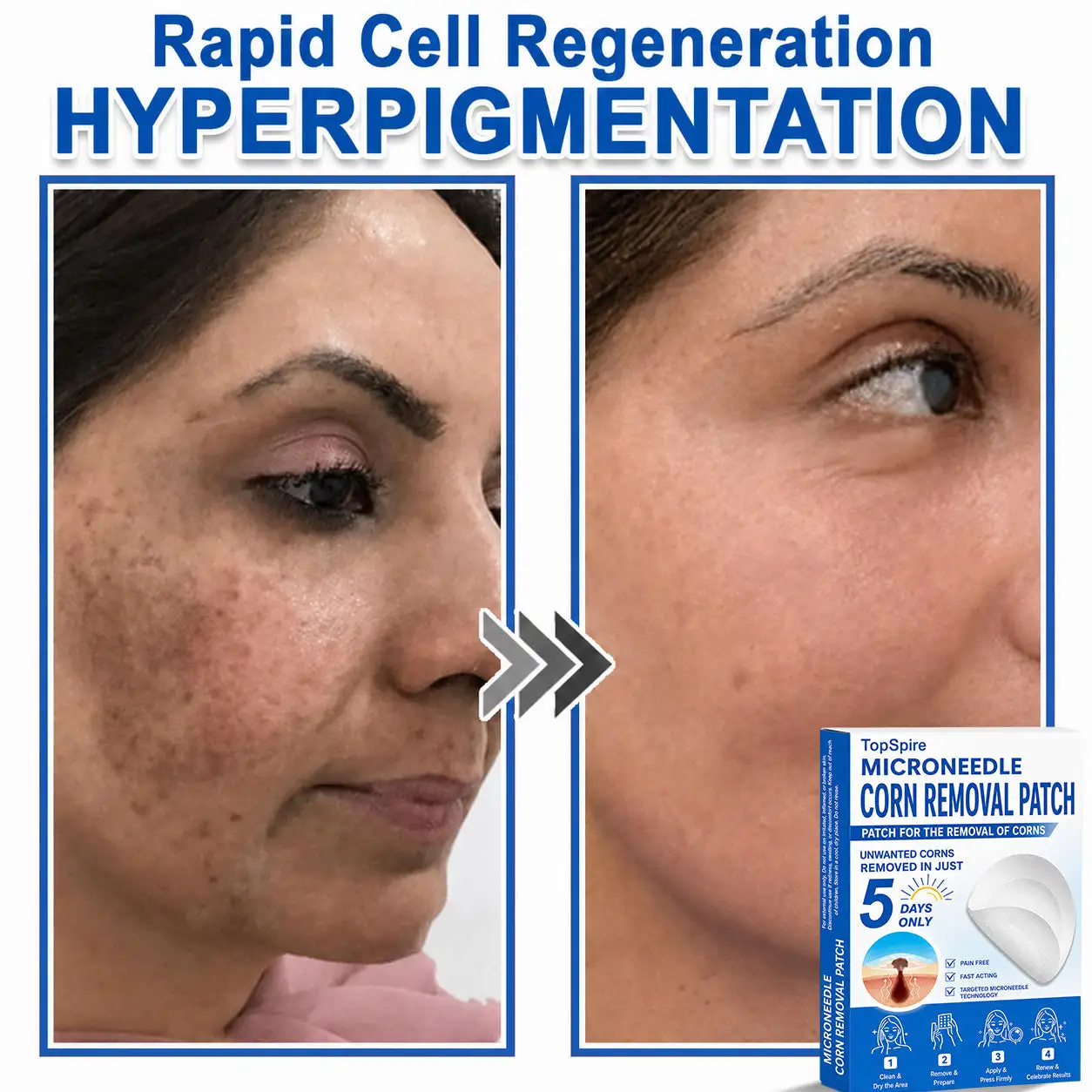 TopSpire® 7-Day Skin Tag & Blemish Remover