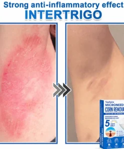 TopSpire® 7-Day Skin Tag & Blemish Remover
