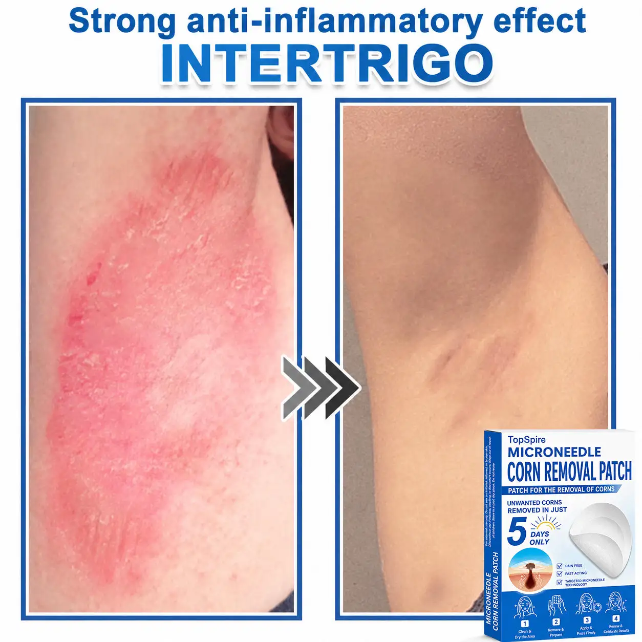 TopSpire® 7-Day Skin Tag & Blemish Remover