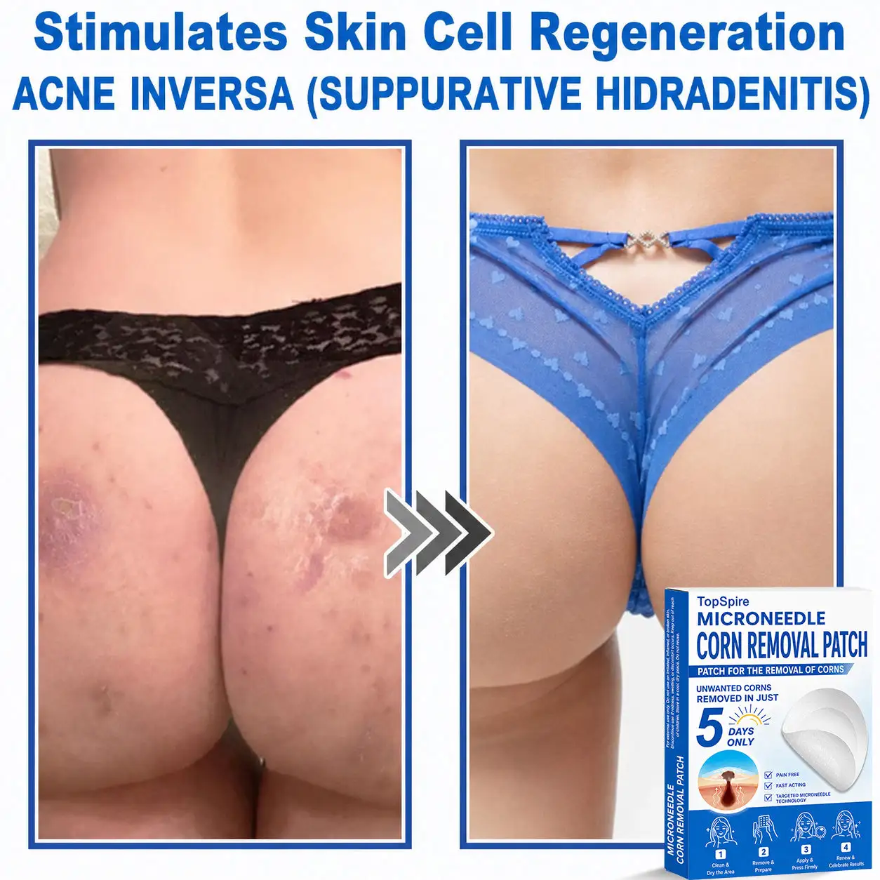 TopSpire® 7-Day Skin Tag & Blemish Remover