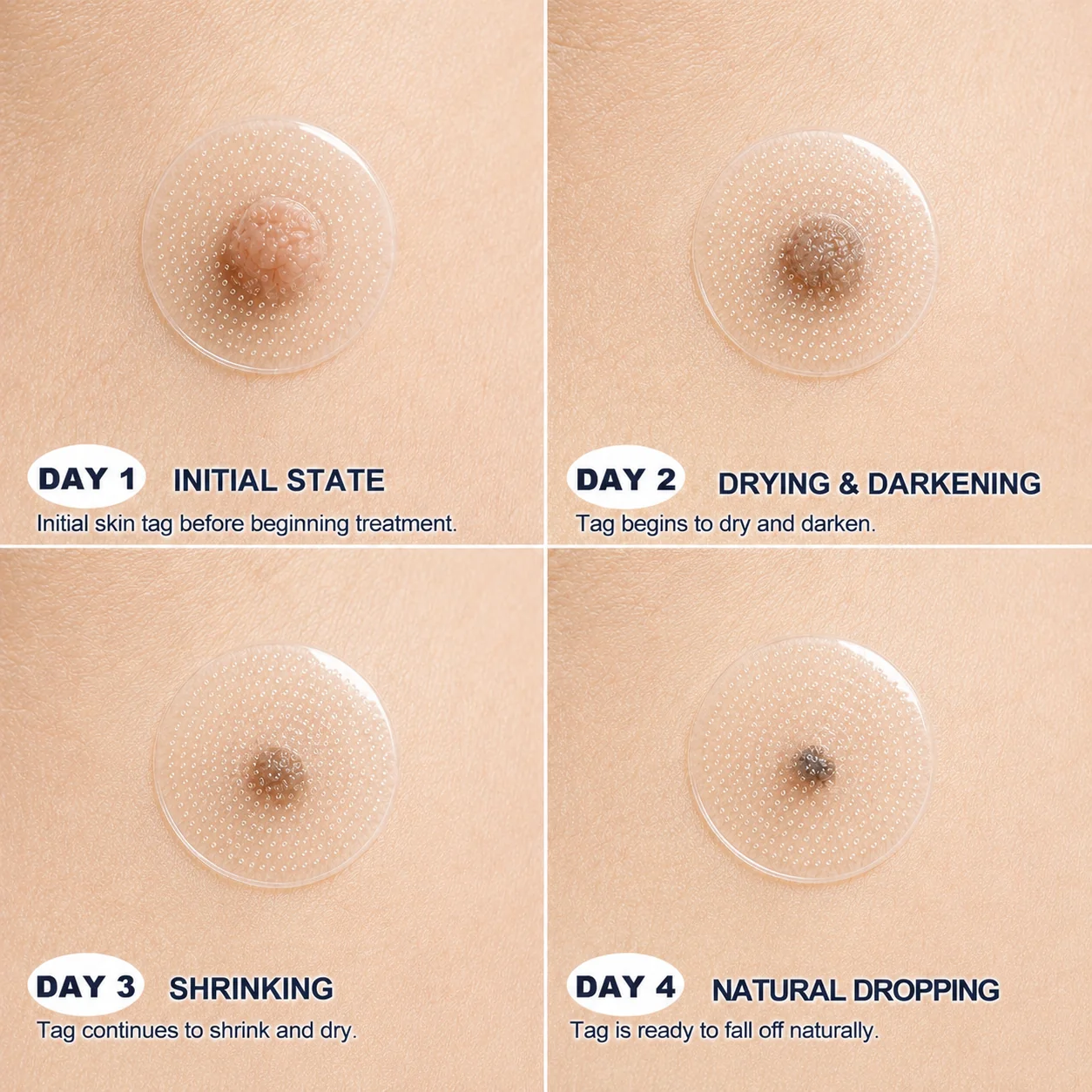 TopSpire® Advanced Microneedle Skin Tag Removal Patch - Image 4