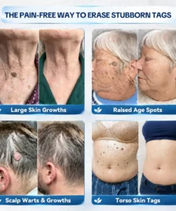TopSpire® 7-𝐃𝐚𝐲 𝐒𝐤𝐢𝐧 𝐓𝐚𝐠 & 𝐒𝐩𝐨𝐭 𝐄𝐫𝐚𝐬𝐞𝐫 𝐂𝐫𝐞𝐚𝐦