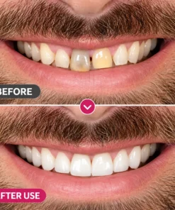 TopSpire™ DenPerm Cavity-Repair Natural Enamel Filling Gel