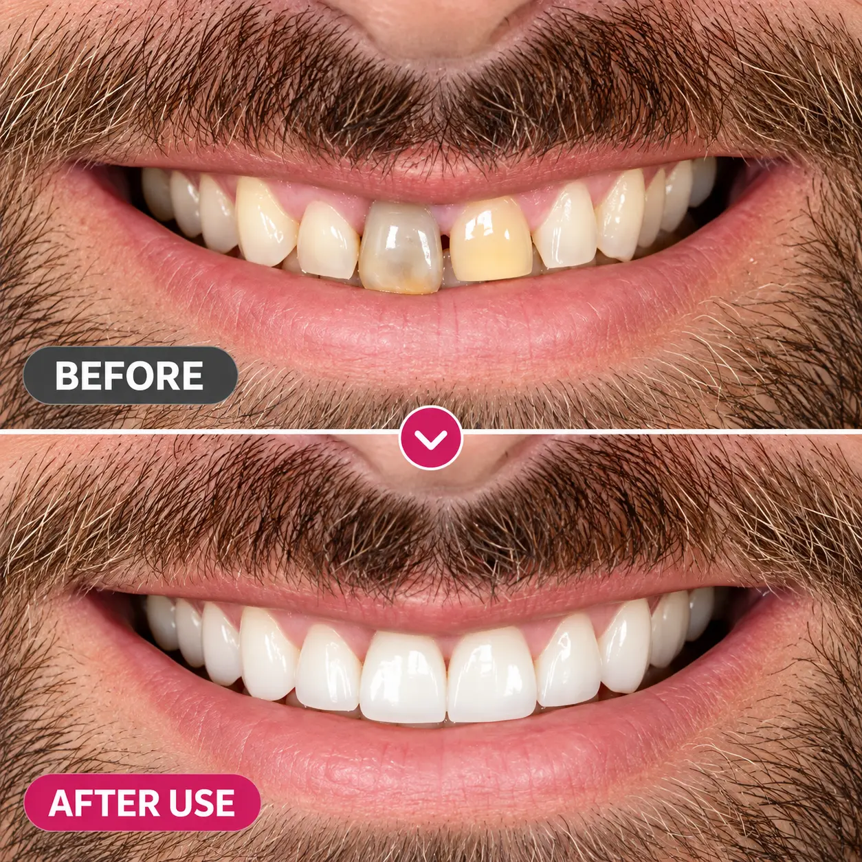 TopSpire™ DenPerm Cavity-Repair Natural Enamel Filling Gel