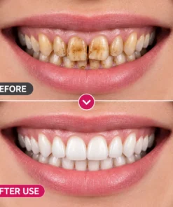 TopSpire™ DenPerm Cavity-Repair Natural Enamel Filling Gel
