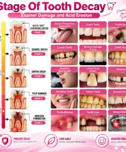 TopSpire™ DenPerm Cavity-Repair Natural Enamel Filling Gel
