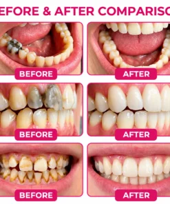 TopSpire™ DenPerm Cavity-Repair Natural Enamel Filling Gel