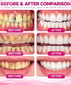 TopSpire™ DenPerm Cavity-Repair Natural Enamel Filling Gel