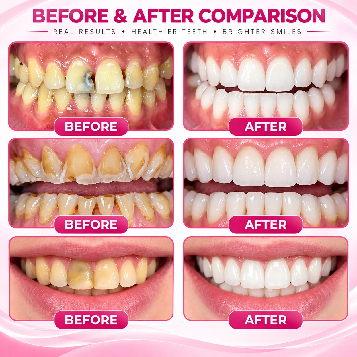 TopSpire™ DenPerm Cavity-Repair Natural Enamel Filling Gel