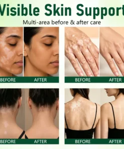 TopSpire® Herbal Vitiligo Cream